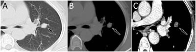 Clinical and imaging features of pulmonary mixed squamous cell and glandular papilloma: a case report and literature review